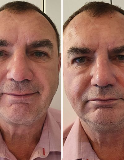 BEFORE & AFTER: Cheek enhancement & under eye filler