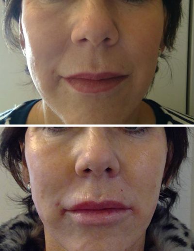 BEFORE & AFTER: Lip & cheek enhancement